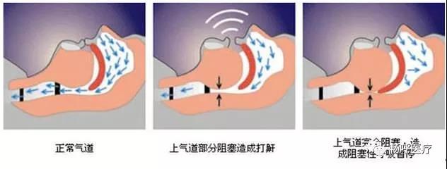 我國(guó)3000萬(wàn)高血壓患者都有這毛病！你知道嗎？